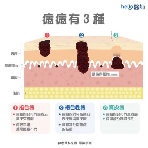 容易長痣|痣形成的原因？痣長毛、痣變多變大是痣病變？5招判。